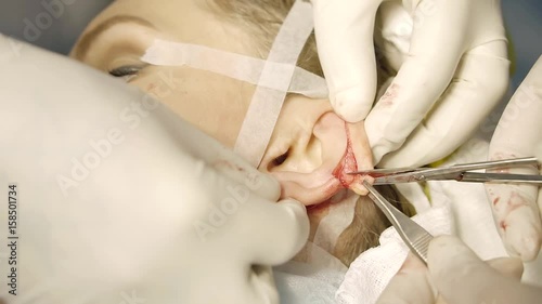 Closeup surgery otoplasty for young women. The surgeon cuts off with scissors the portion of the ear to further reduce it. photo