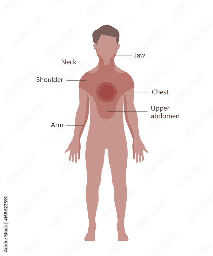 Fototapeta premium Heart Attack Pain Location