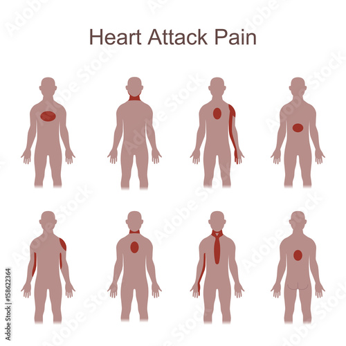 Heart Attack Pain Location