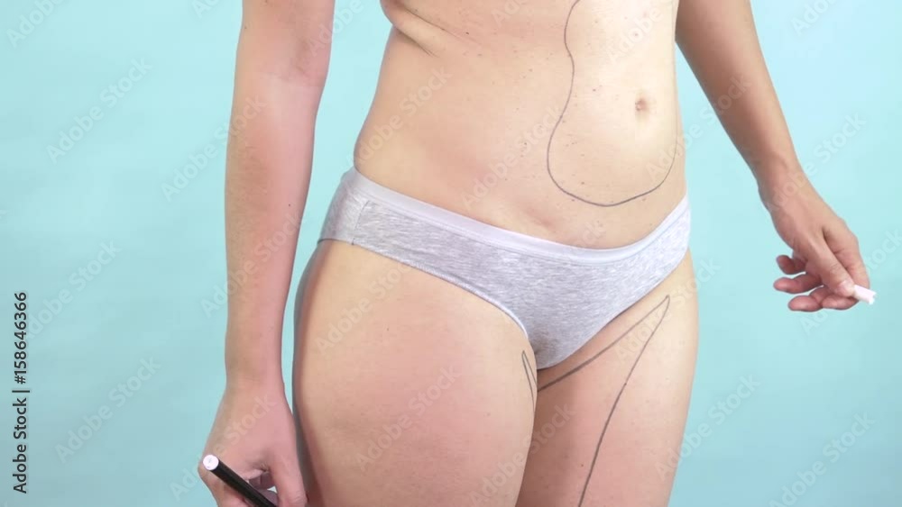 Woman drawing body plastic surgery lines to slim and reduce fat. Caucasian female torso with correction mark for cosmetic liposuction of hips and thighs. Body control, weight loss, cellulite removal Woman drawing body plastic surgery lines to slim and reduce fat. Caucasian female torso with correction mark for cosmetic liposuction of hips and thighs. Body control, weight loss, cellulite removal