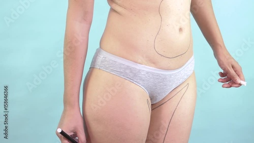 Woman drawing body plastic surgery lines to slim and reduce fat. Caucasian female torso with correction mark for cosmetic liposuction of hips and thighs. Body control, weight loss, cellulite removal