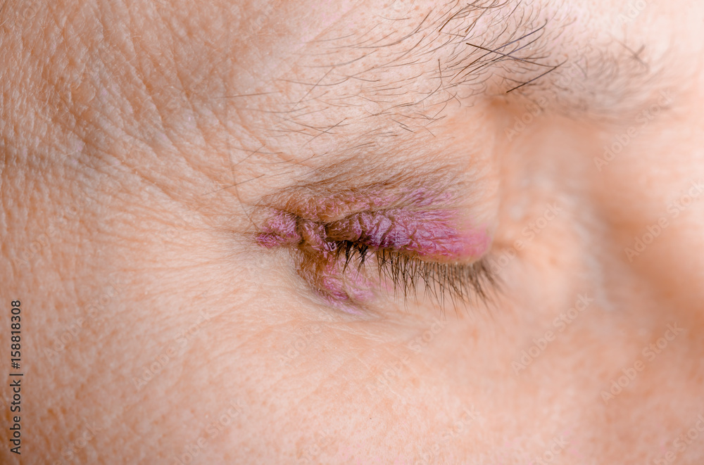 Obraz premium Woman's eye injured due to rupture of capillary, causing hematoma or bruising. It could also be conjunctivitis or other allergic eye inflammation