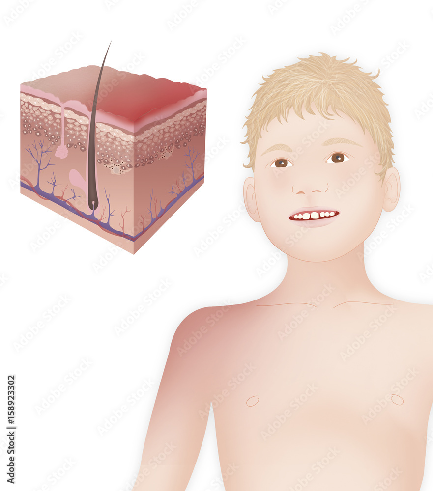 Sunburn, drawing Stock Illustration | Adobe Stock