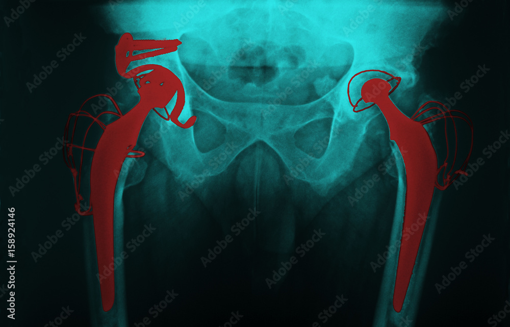 Hip prosthesis, xray Stock Photo Adobe Stock