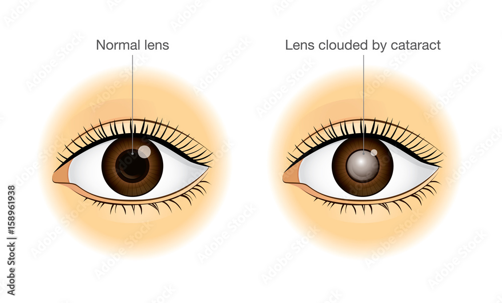 The difference between normal eye and lens clouded by cataract