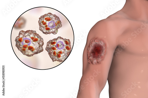 Cutaneous leishmaniasis ulcer and close-up view of Leishmania amastigotes infected human histiocyte cells, 3D illustration photo