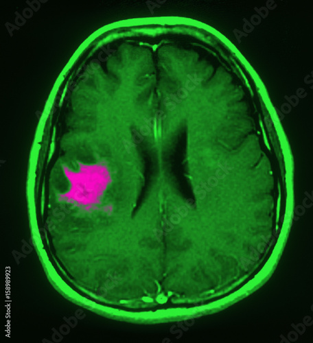 Nmr cerebral lymphoma photo