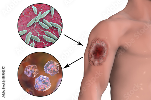 Cutaneous leishmaniasis ulcer and close-up view of Leishmania promastigotes, up, and amastigotes infected human histiocyte cells, bottom , 3D illustration photo