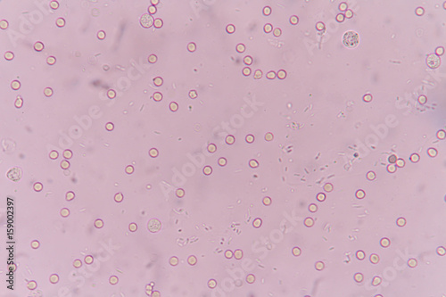 white blood cells and red blood cells in urine