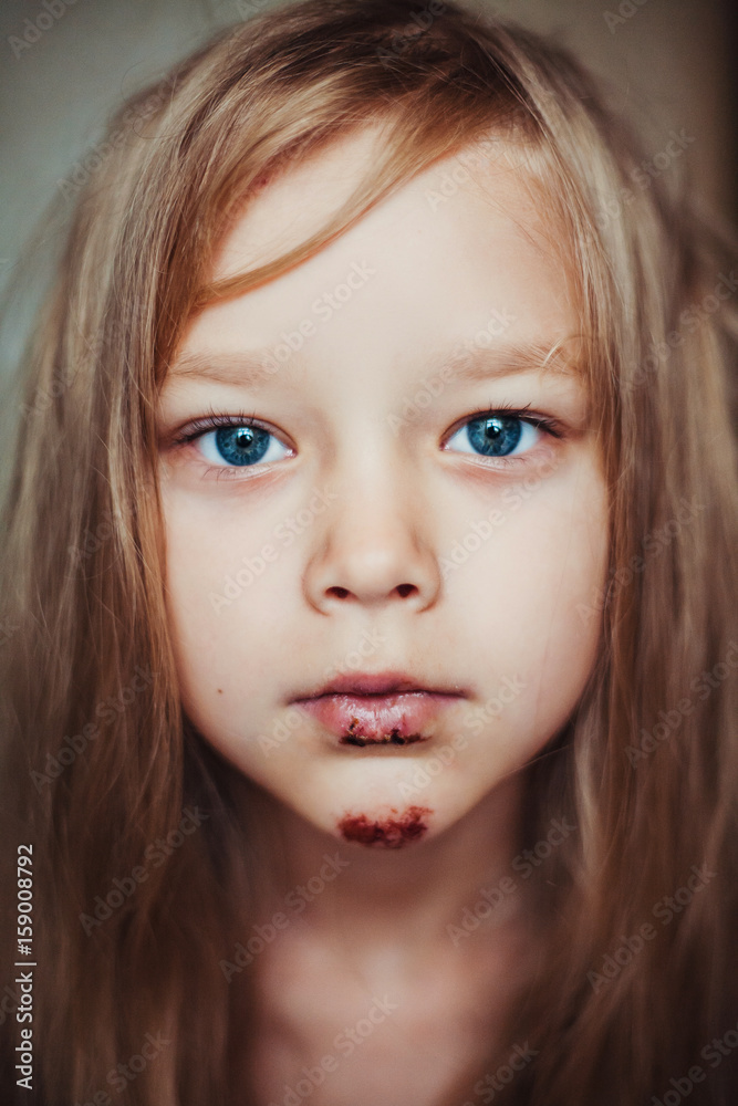 Cute little girl with blood wound on her face. Cute little girl with blood wound on her face.