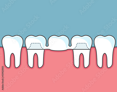 Dental bridge and row of teeth