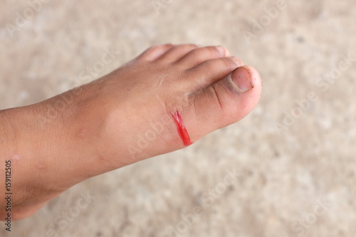 Blood from child's foot caused by the accident.