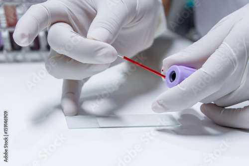 blood sample for hematocrit testing on white background
