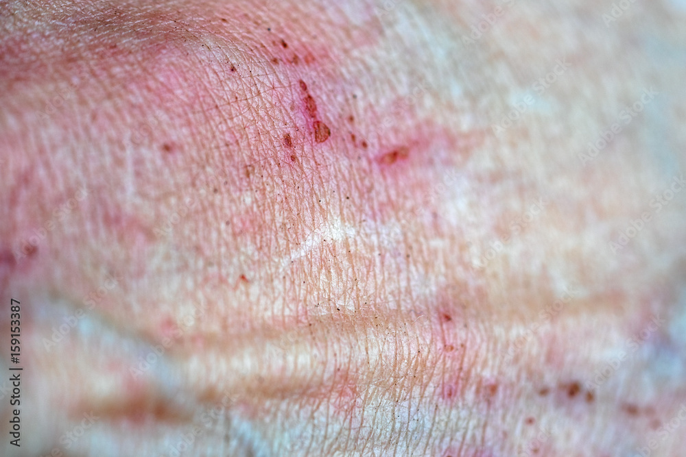 Fototapeta premium bad disease skin texture close up