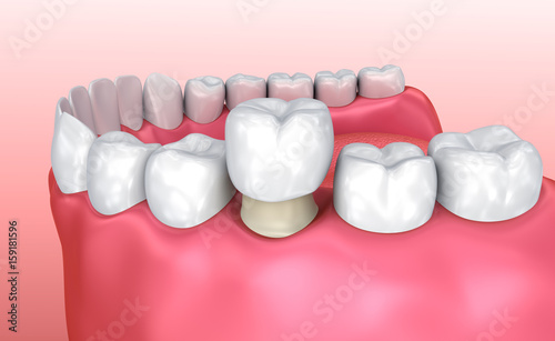 Fototapeta Naklejka Na Ścianę i Meble -  Dental crown installation process, Medically accurate 3d illustration