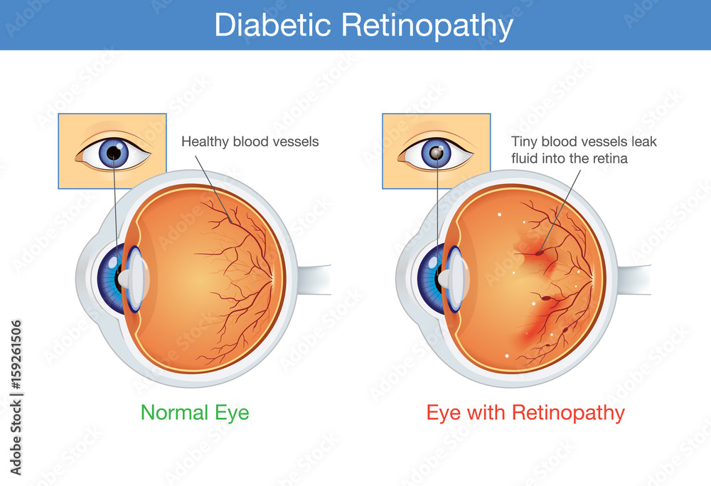 Anatomy of normal eye and Diabetic retinopathy in people who have diabetes. Illustration about health and eyesight.