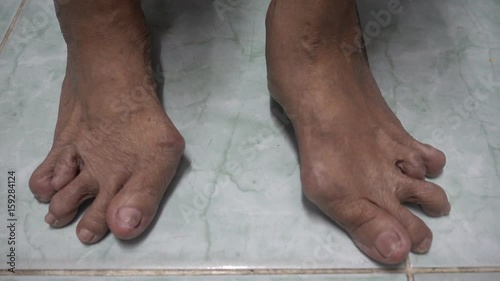 Old woman's foot deformed from rheumatoid or gout arthritis photo