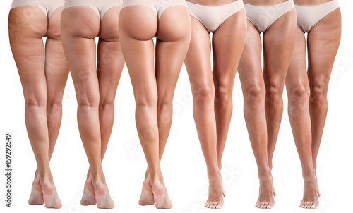 Female buttocks before and after treatment. photo