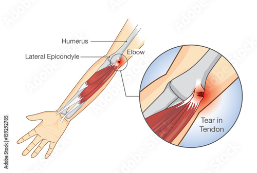 Muscle injury and tear in tendon at elbow area. Illustration about medical and health.