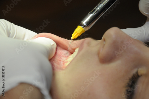 GINGIVAL GRAFT photo