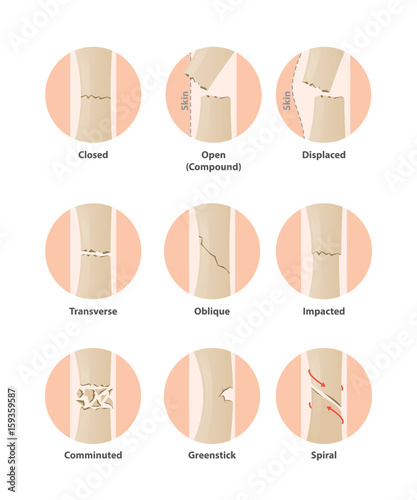 Fotografia Type of fracture in circle illustration vector on white background
