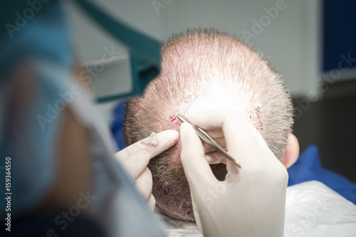 Surgeon doing hair transplantation in hospital