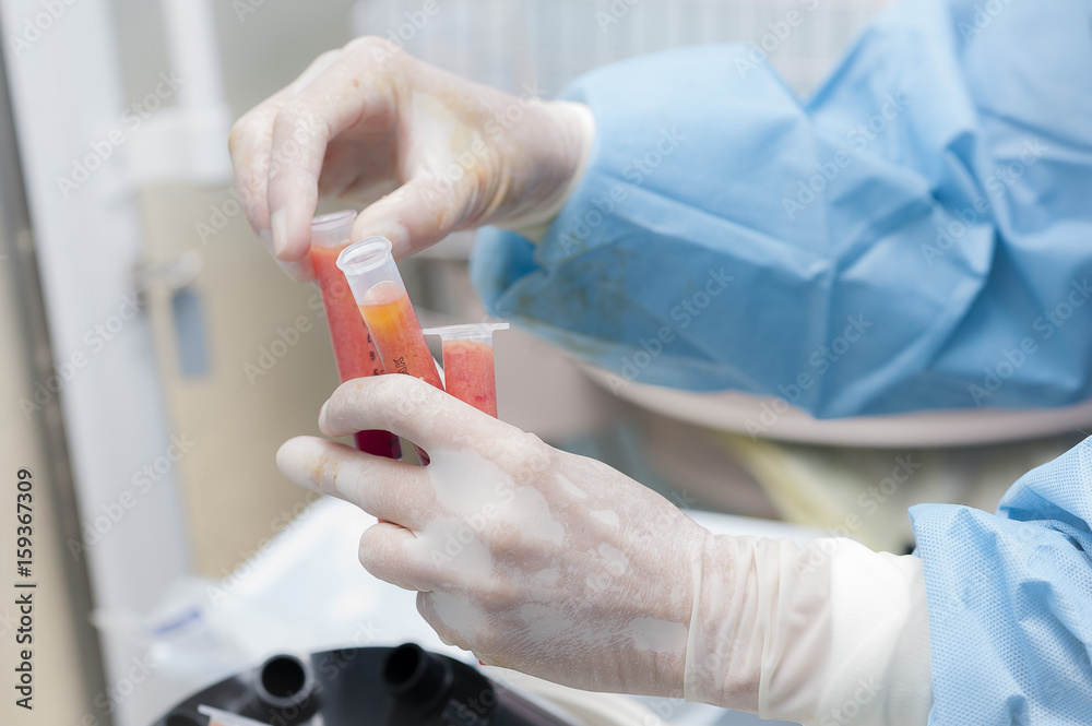 LIPOFILLING LIPOFILLING
