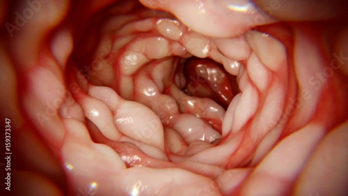 Crohn's disease intestine, animation photo