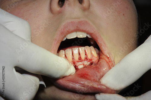GINGIVAL GRAFT