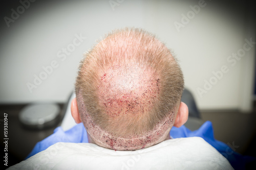 Patient in hospital for hair transplantation