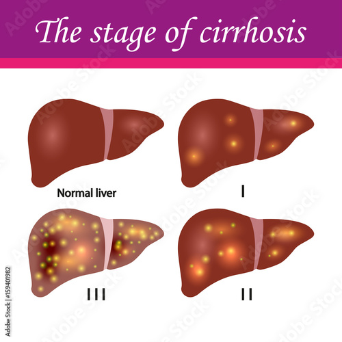 cirrhosis of the liver stages