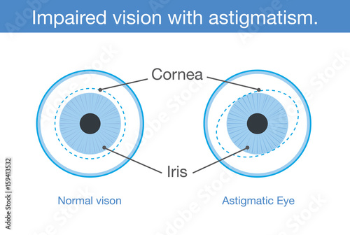 The different between normal vision and Impaired vision with astigmatism in front view. Illustration about common eye problem.