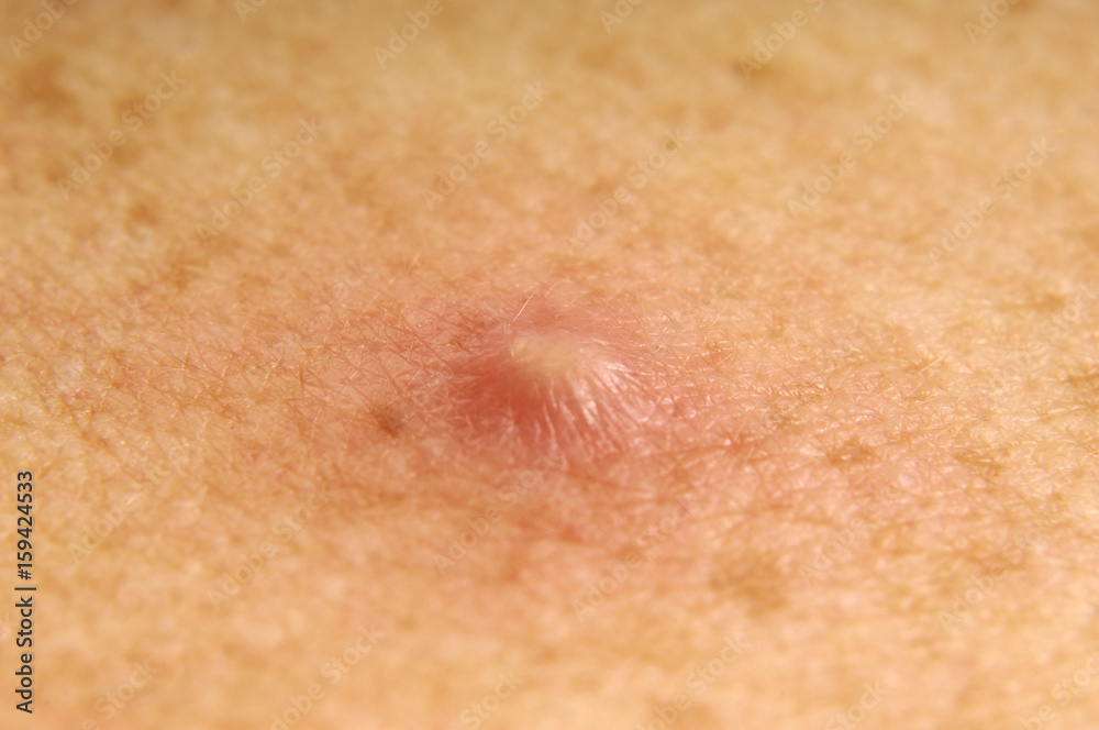 Fototapeta premium blemish of pus