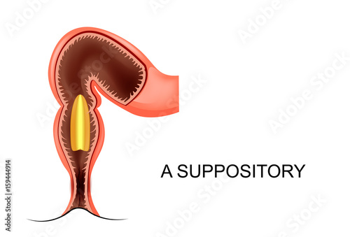 a suppository in the anus photo