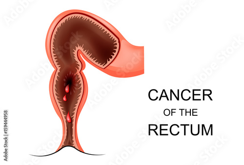 cancer of the rectum photo