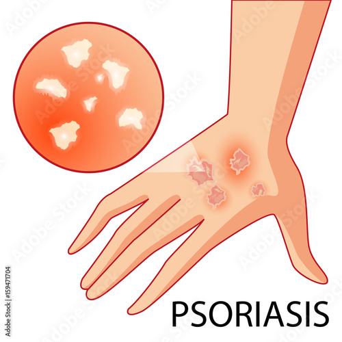 Psoriasis. Skin problems. Vector. Cartoon. Isolated. Flat. Illustration for websites, brochures, magazines. Medicine.