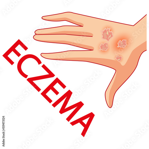 Psoriasis. Skin problems. Vector. Cartoon. Isolated. Flat. Illustration for websites, brochures, magazines. Medicine.