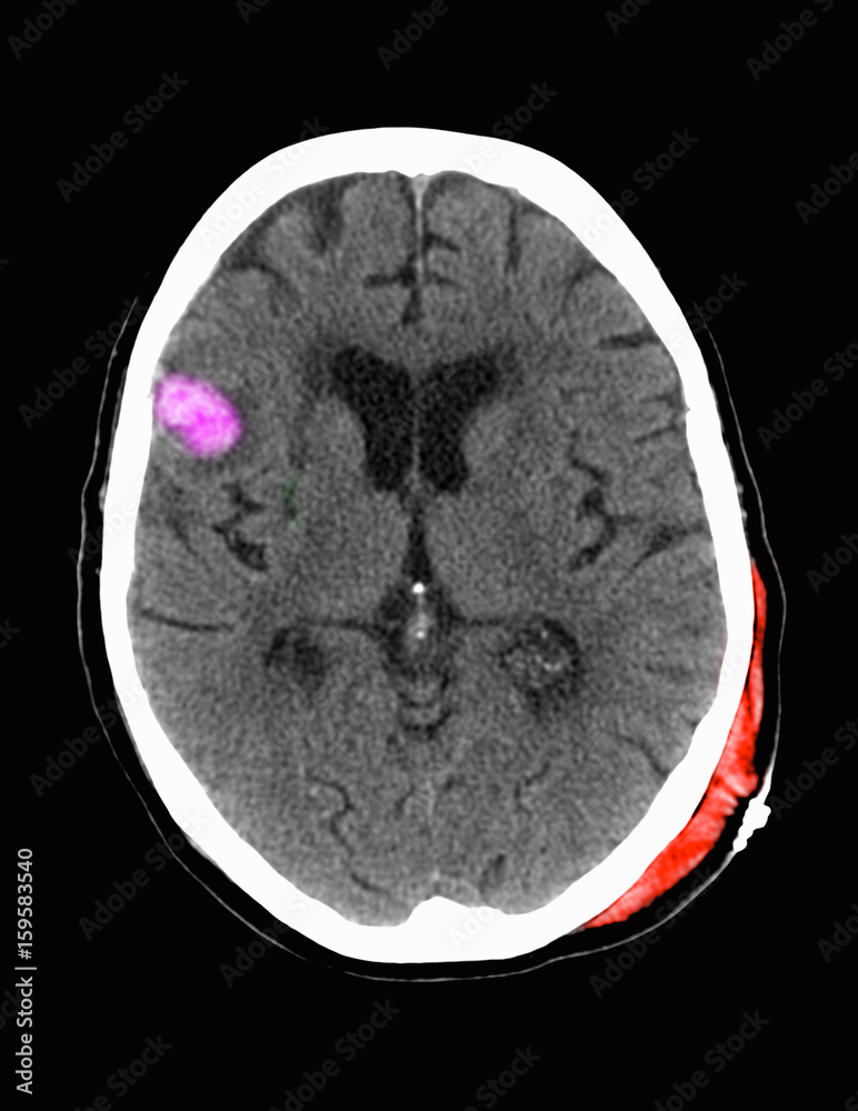 Contrecoup right frontal hemorrhagic contusion Contrecoup right frontal hemorrhagic contusion