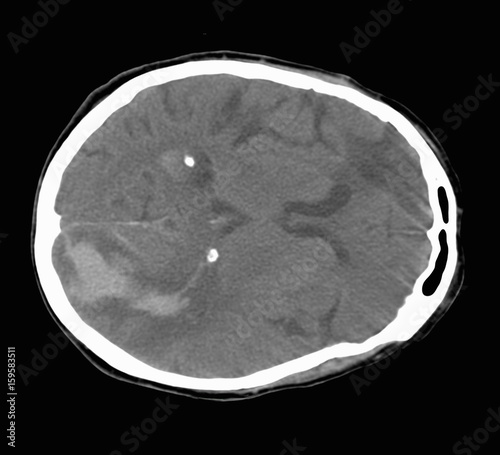 CT scan of the brain showing a stroke