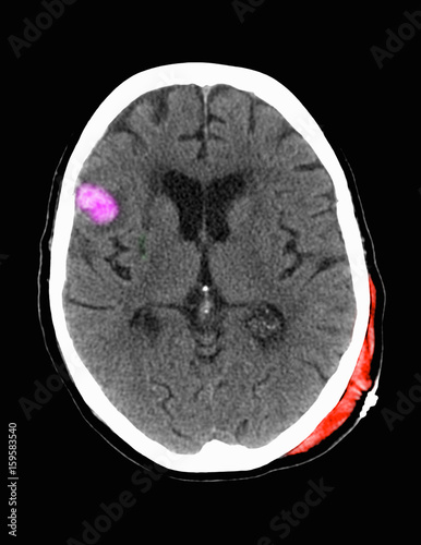Contrecoup right frontal hemorrhagic contusion photo