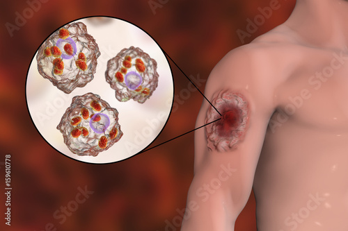 Cutaneous leishmaniasis ulcer and close-up view of Leishmania amastigotes infected human histiocyte cells, 3D illustration
