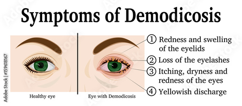 Illustration of Demodicosis