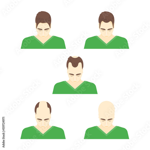 Cartoon Stages of Hair Loss in Men. Vector