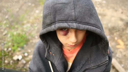 The boy is a teenager with a hematoma and a bruised eye that looks into the camera. photo