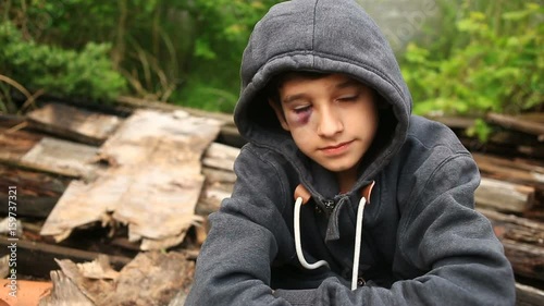 The boy is a teenager with a hematoma and a bruised eye that looks into the camera. photo