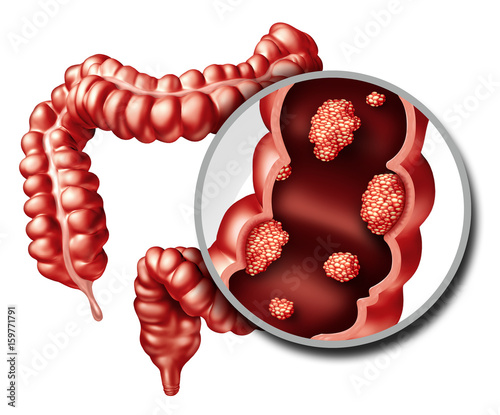 Colon Cancer Concept