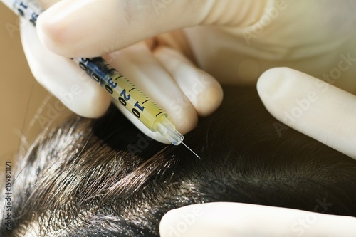 Doctor injecting at patient's hair and scalp, Dermatologist exam scalp disorder. (Selective Focus)
