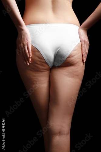 Woman with cellulite problem on black background