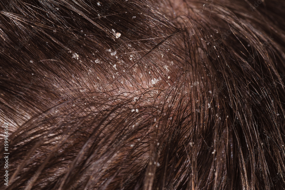Fototapeta premium Dandruff on male dark hair