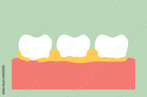 periodontal disease with dental plaque or tartar